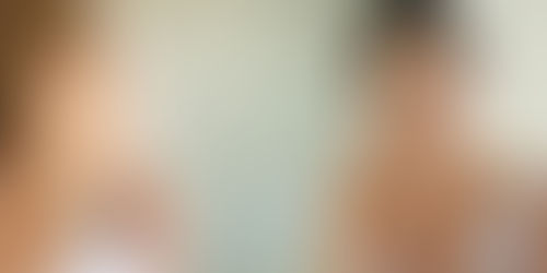 Common Types of Acne and How to Treat Them