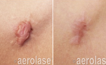 Scar Reduction4 - Pair
