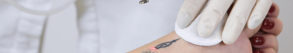 Laser-Tattoo-Removal-IN_00-1024x669.png