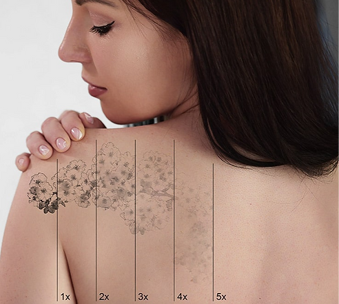 laser-tattoo-removal_edited.png