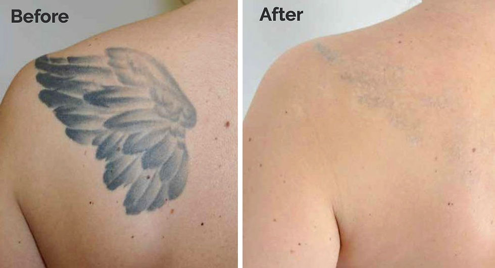 Best result laser tattoo removal in Toronto
