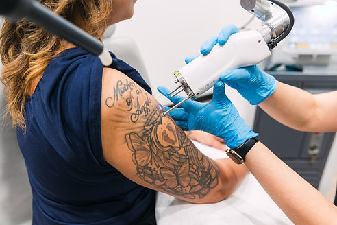 Erasable-Med-Spa-Tattoo-Removal-9568.jpg