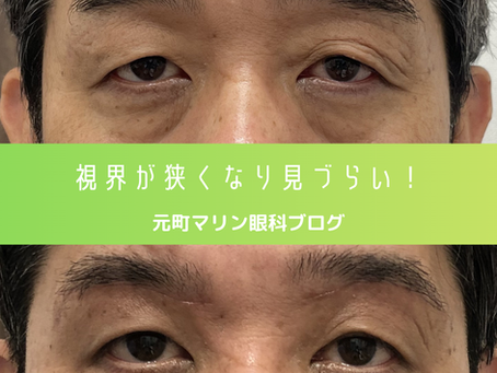 【50代男性】眉下切開で視野広々、若々しい目元へ