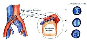 Diagram of compressed iliac vein with 3 NIVL cross sections