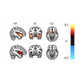Longitudinal course of cannabis-induced psychosis (CIP)