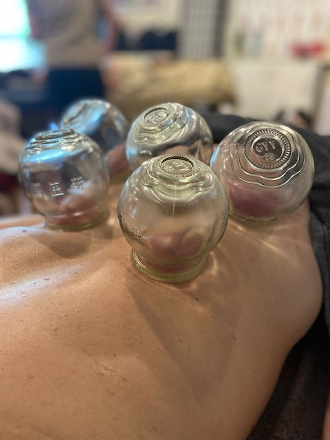 Close-up view of traditional glass cupping cups on skin