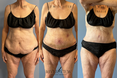 TummyTuckTransformation.png