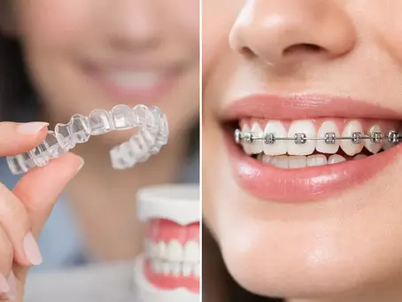 Invisalign o brackets metálicos: qué elegir