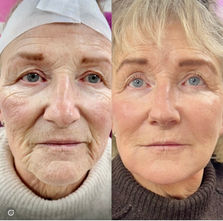 Before and after facial rejuvenation results on older woman.