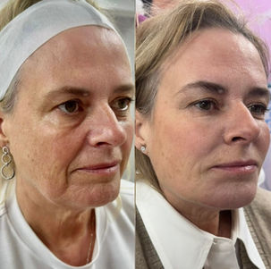 Before and after skin rejuvenation treatment results