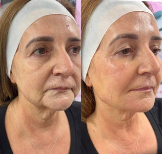 Before and after skin rejuvenation treatment results