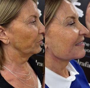 Before and after skin rejuvenation treatment results