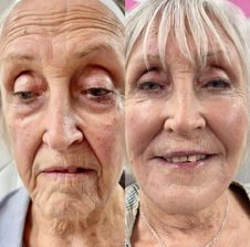 Before and after Signature Liquid Facelift results.