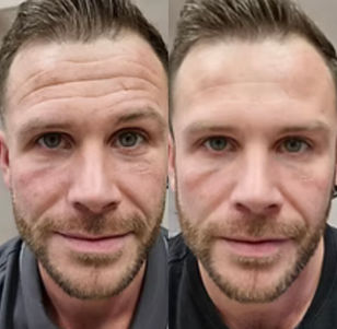 Before and after forehead wrinkle treatment results on a man