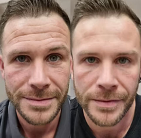 Before and after forehead wrinkle treatment results on a man