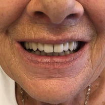 Woman smiling, showing her new dentures