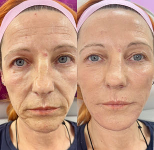 Before and after skin rejuvenation treatment results.