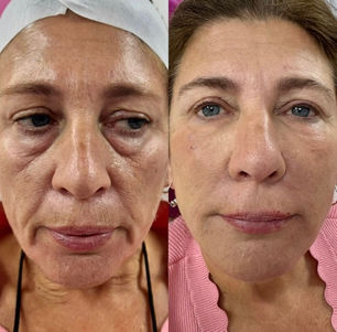 Before and after facial skin tightening results
