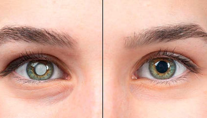 Understanding Cataract: Causes, Symptoms, and Treatment Options