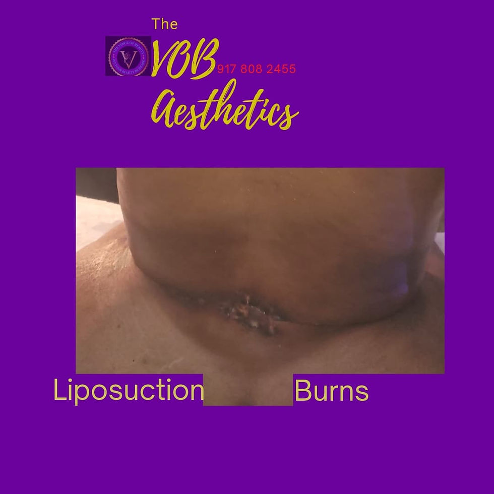 Lipo Burns