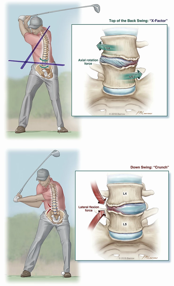 Golf and low back pain
