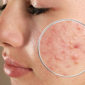 Tratamento de Acne