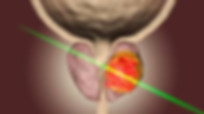 علاج تضخم البروستاتا