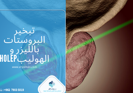 تبخير البروستات بالليزر و الهوليبHOLEP