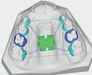 Thumbnail: 3D CAD-CAM Expander Software