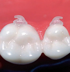 Ceramic Invisalign Buttons Natura CLEAR BUTTONS ceramic curved | OrthoFlex