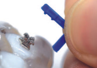 Thumbnail: DIGITALLY-ASSISTED INDIRECT BONDING SYSTEM(patented)