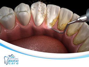 Why Do My Teeth Feel Weird After a Cleaning?