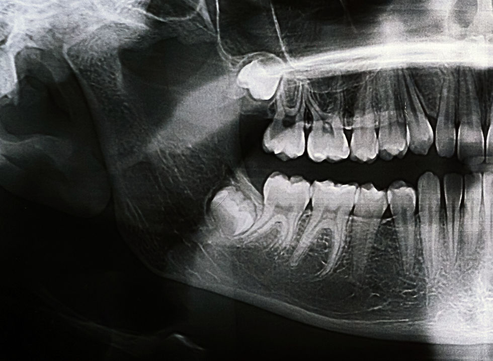 X-ray showing impacted wisdom teeth, a common reason for extraction