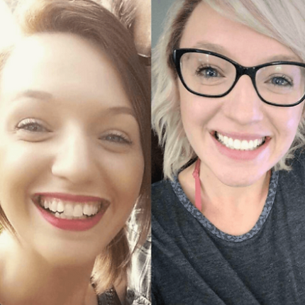 invisalign before and after