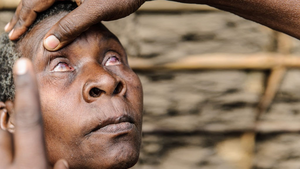 trachoma_edited.jpg