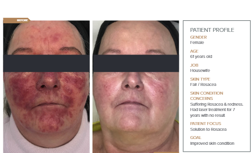 before an after of treatment