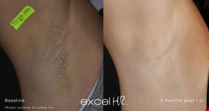 laser hair removals