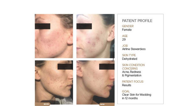 Facial acne treament