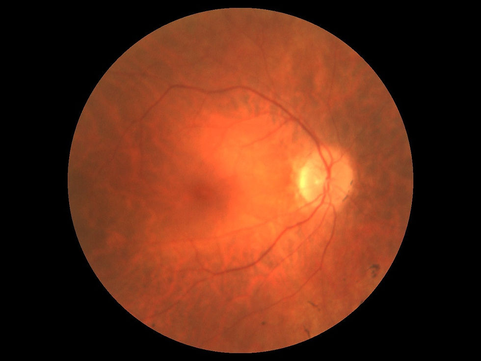 My photo from 2008, the dark clouding around the edge is the speckling