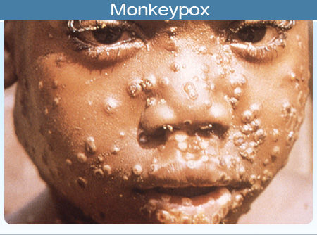 Monkeypox Outbreak Hits Bayelsa, Doctor, 10 Others Quarantined