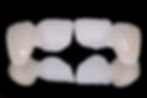traitement bridge cantilever
