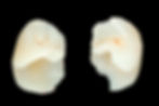 Inlay / Onlay