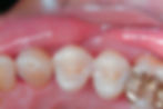 inlay onlay