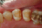 Inlay / onlay
