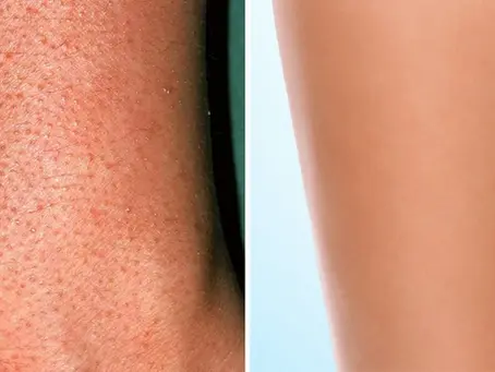 How to get rid of Strawberry legs with laser hair removal.