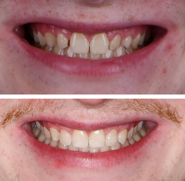 Veneers_subpage1_edited.png