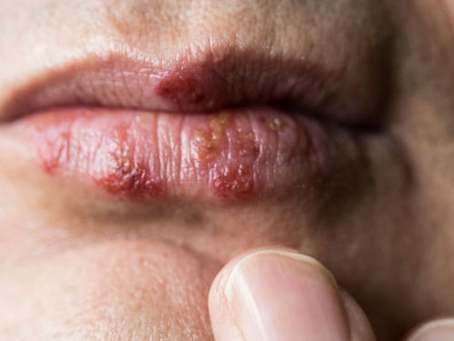 Que es Herpes Labial: Causas y Tratamientos. Lo que todo Micropigmentador debe Saber