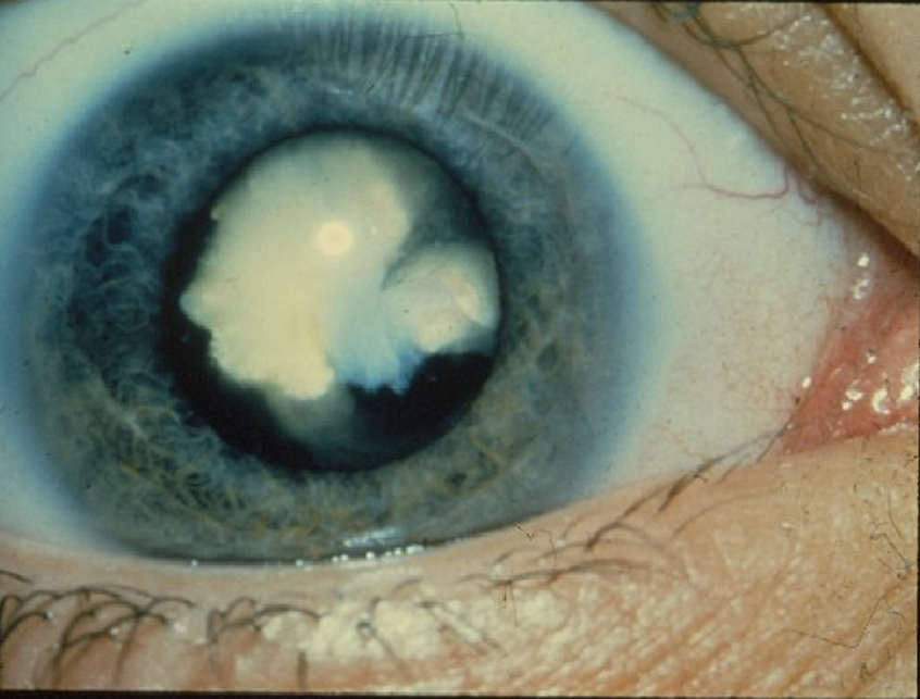 Identifying A Contact Lens Infection Treatment and Prevention For