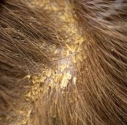 Understanding Seborrhea