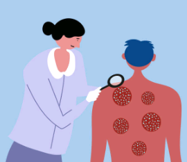 10 remèdes naturels pour soulager le psoriasis